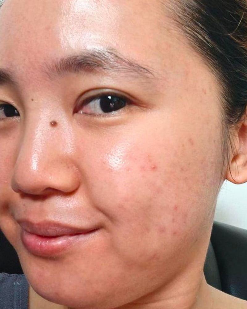 PIGMENTATION before