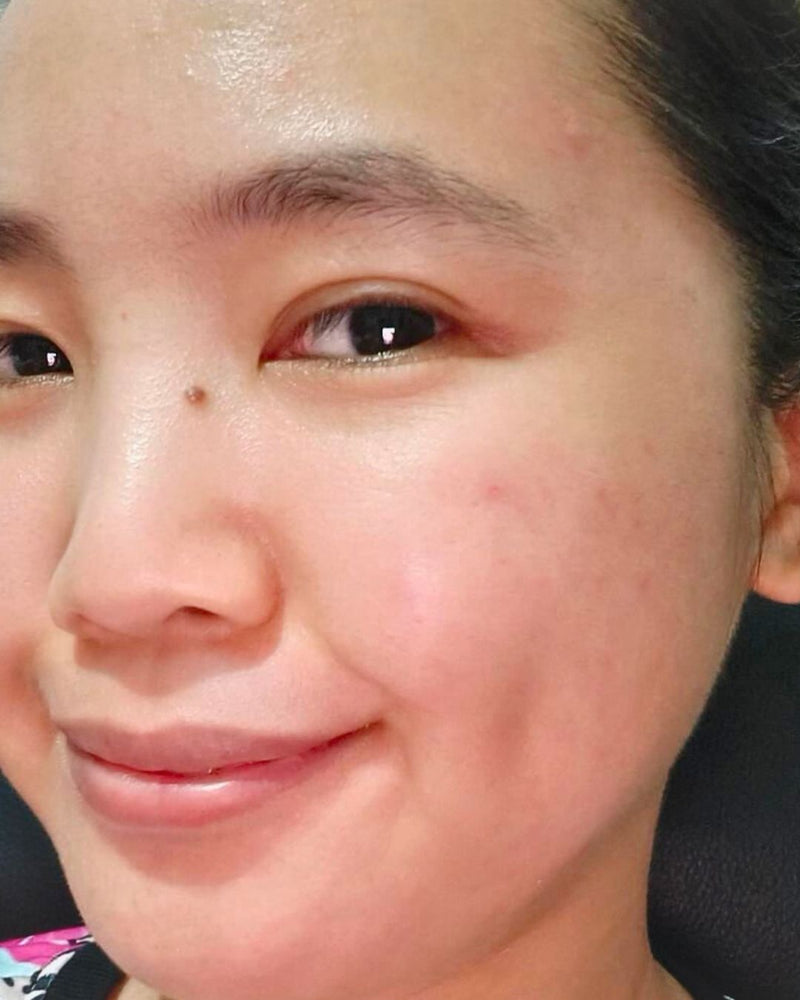 PIGMENTATION after