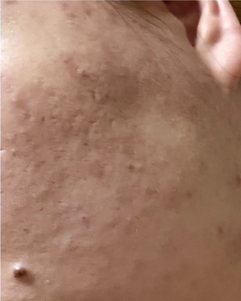 ACNE SCARS before