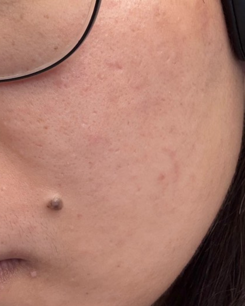 ACNE SCARS after