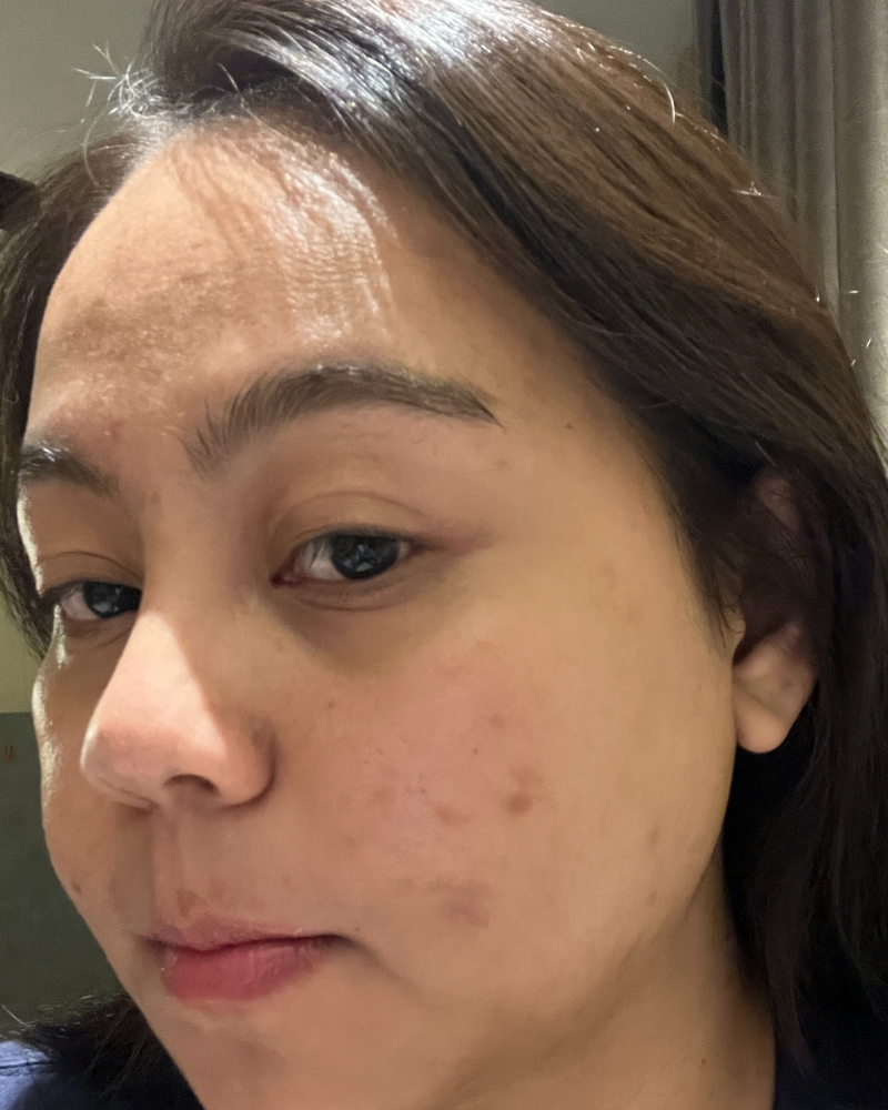 BLEMISHES before