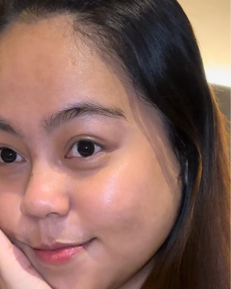 BLEMISHES after